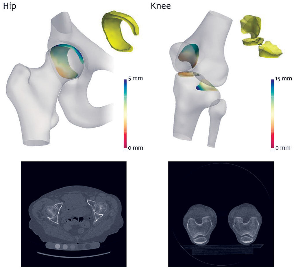3D images see arthritis early