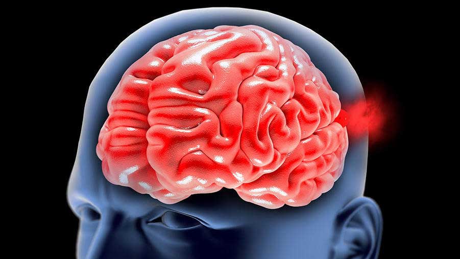 Brain bleeds up in patients with COVID treated for ischemic stroke