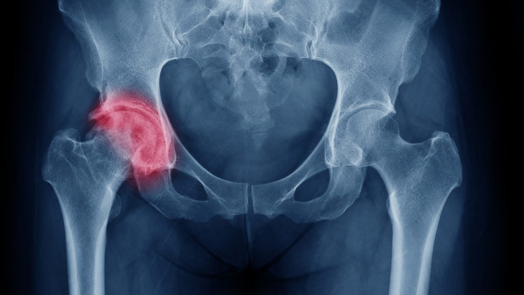 Review highlights overlooked problem of osteoporosis in men