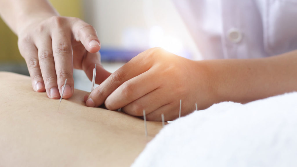 Medicare might cover acupuncture treatments for lower back pain