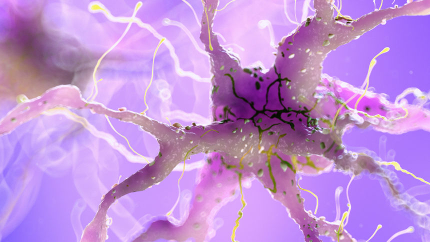 Artist's rendering of a brain cell damaged by amyloid beta plaque in Alzheimer's disease