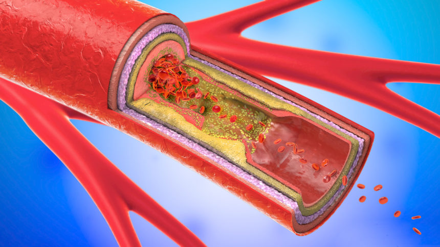 cutaway of blood vessel shows arteriosclerosis