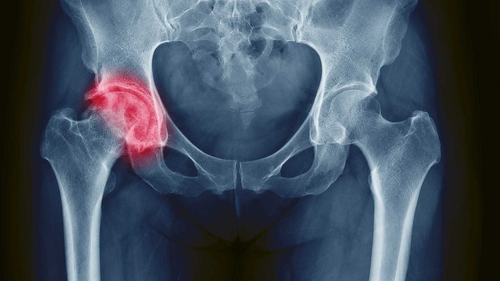 Pneumonia twice as deadly as a broken hip in the elderly: study