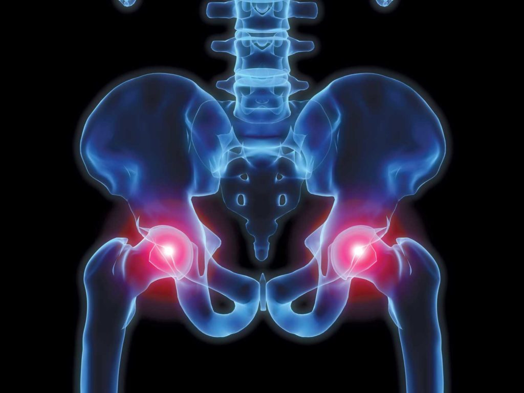 Study shows hip protectors significantly cut fracture risk