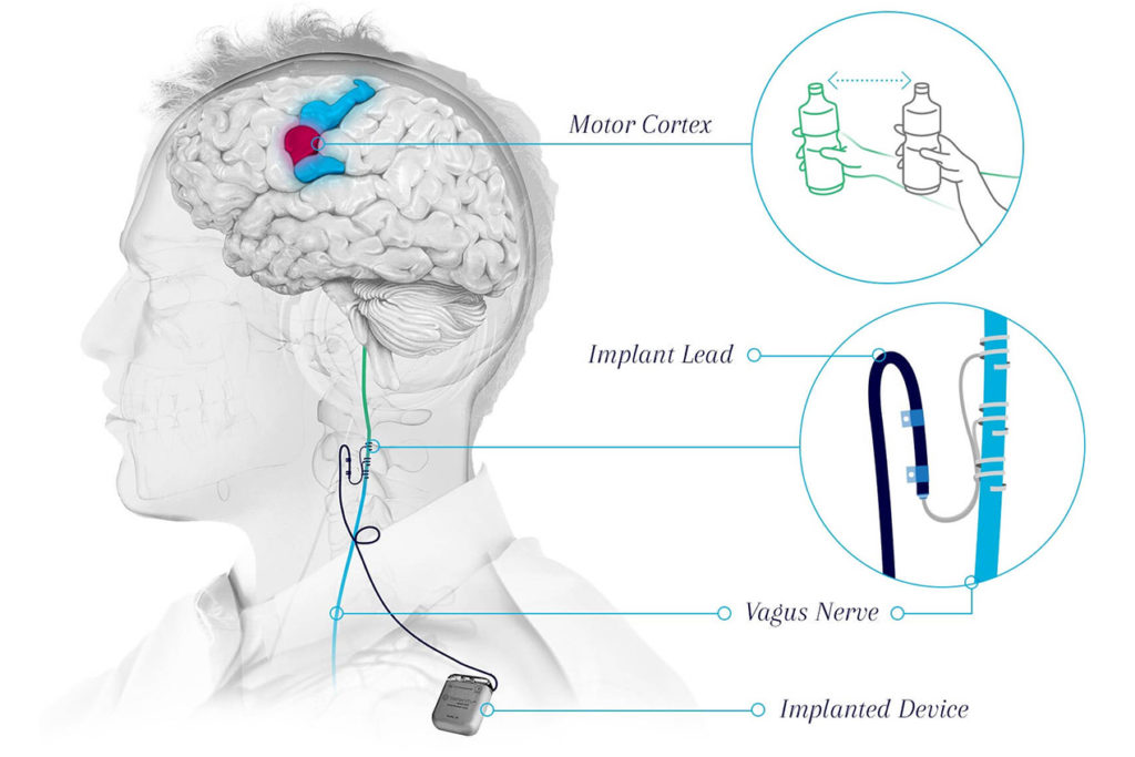 Drawing of human head and neck with MicroTransponder Vivistim Paired VNS System; Image credit: MicroTransponder