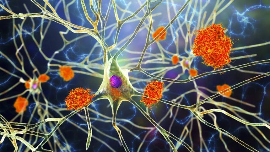 Artist's representation of amyloid beta plaques on brain nerve cells