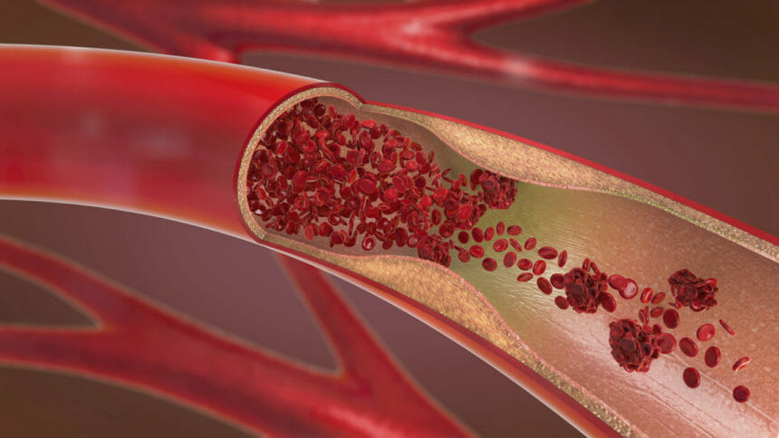 3d illustration of a constricted and narrowed artery (arteriosclerosis); Image credit: Getty Images