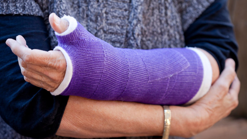 Closeup of woman holding her broken arm in a cast